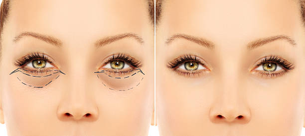 다크서클 개선 효과