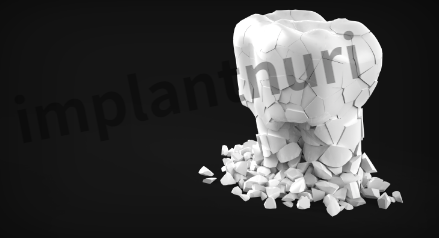 무치악 임플란트 개수