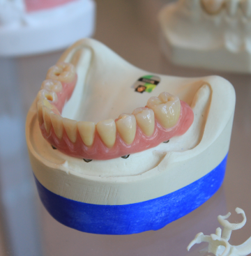 라미네이트 부작용