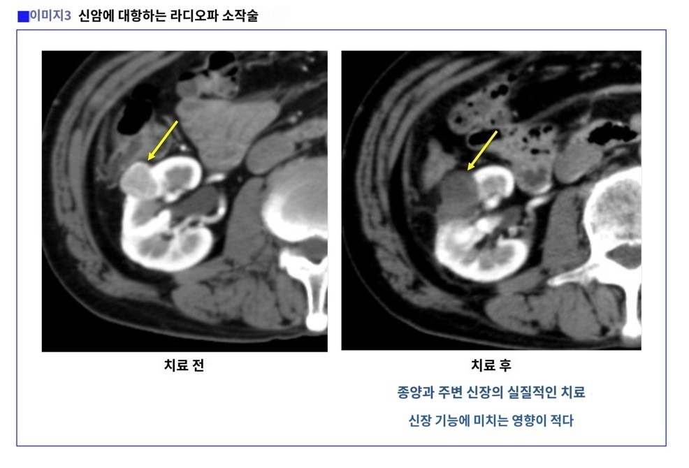 라디오파 암치료