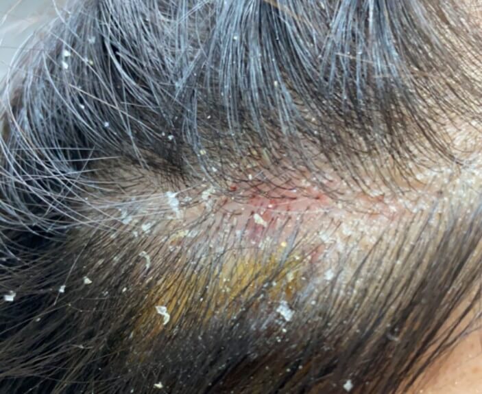 지루성 두피염으로 인한 비듬과 붉은색 반점