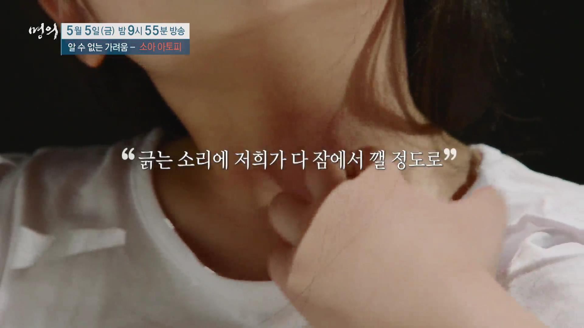 명의 어린이 소아 아토피 피부염 스테로이드 효과 및 부작용 완치 치료제 신약 비용 방법
