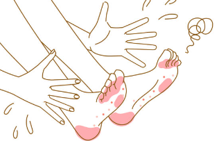 무좀
