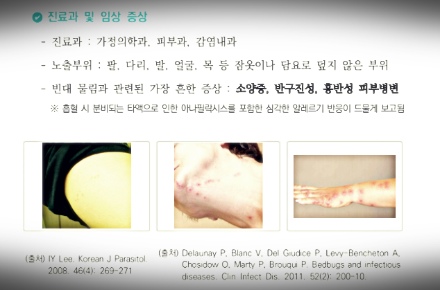 빈대의 증상