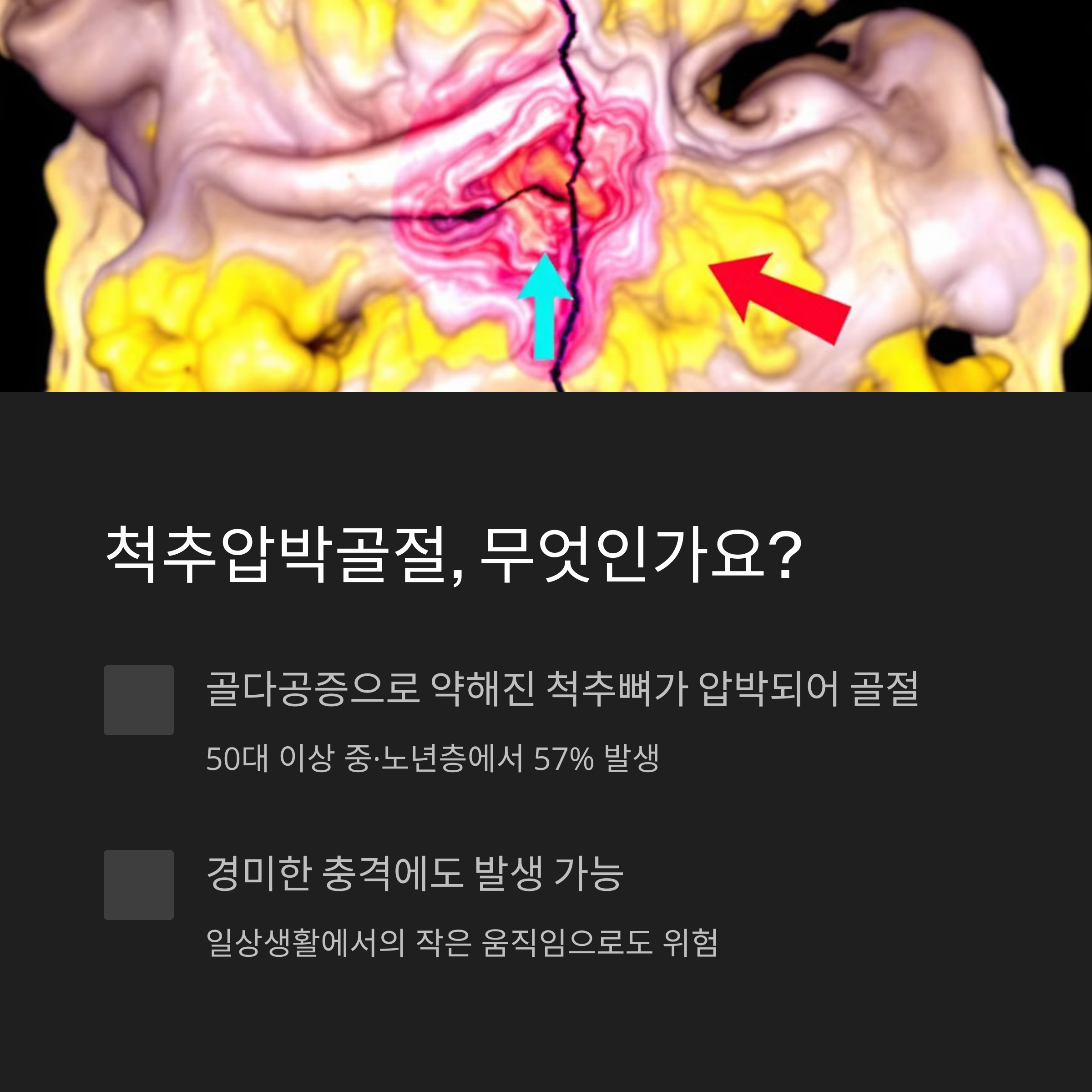 척추압박골절, 무엇인가요?