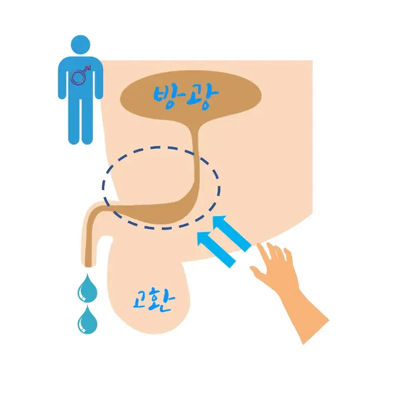 남자-잔뇨감-없애는-법-밀킹-milking