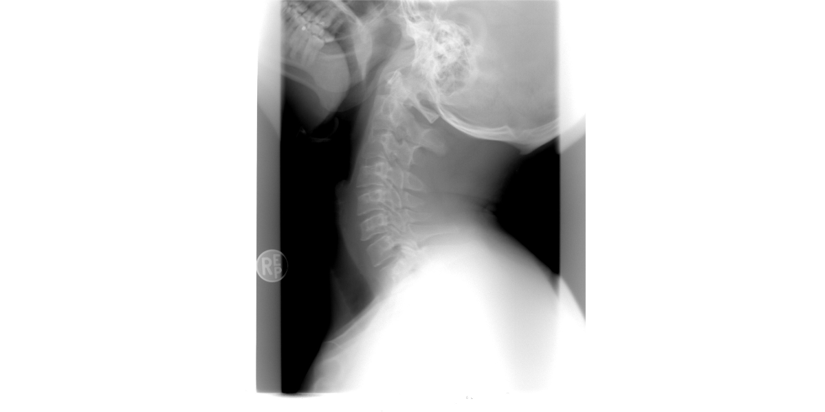 거북목 증상과 원인