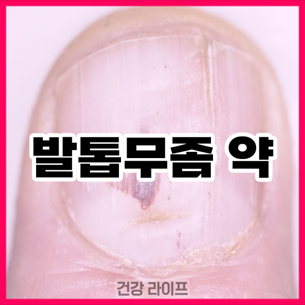 발톱무좀 약