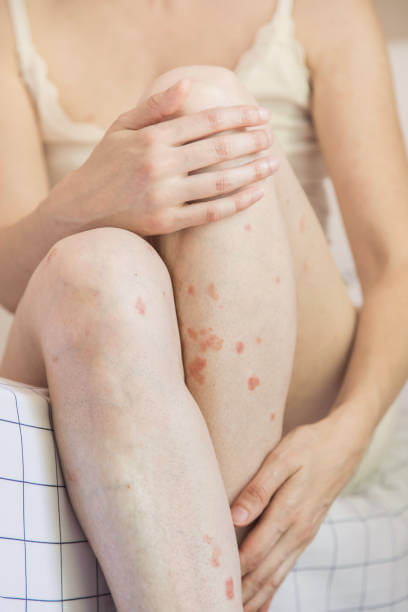 대상포진 예방접종 가격