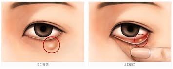 눈다래기 원인