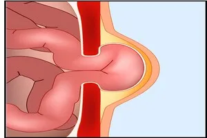 탈장-수술-비용