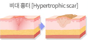 비후성 흉터