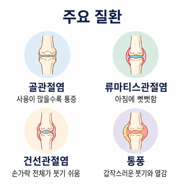 골관절염, 류마티스관절염, 건선관절염, 통풍 등 손가락 마디 통증과 관련된 주요 질환을 비교한 그림