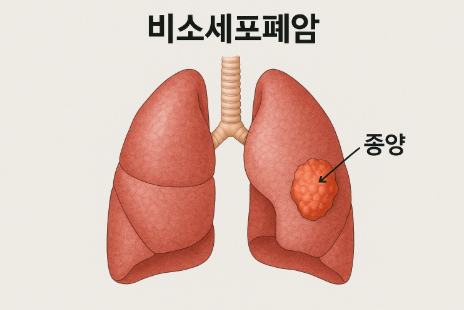실제 폐암 환자