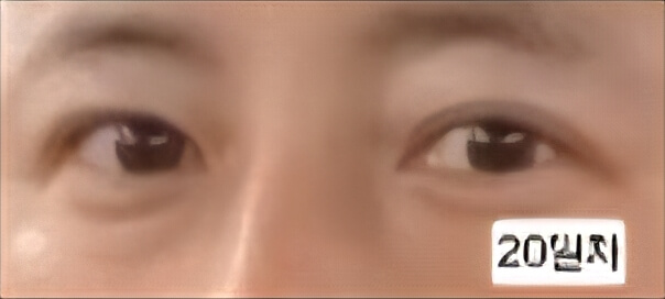 유행성각결막염 치료과정 증상 시력저하 회복과정 발병2주 3주 기록