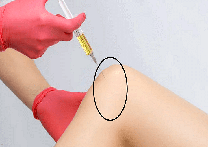 무릎연골 주사기