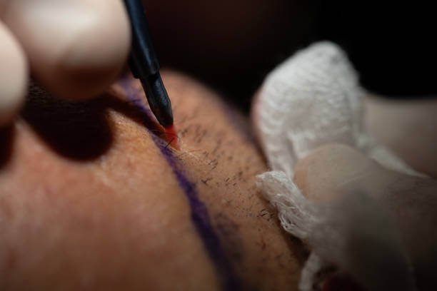 구렛나루 이식, 부작용 없는 병원 고르는 법?