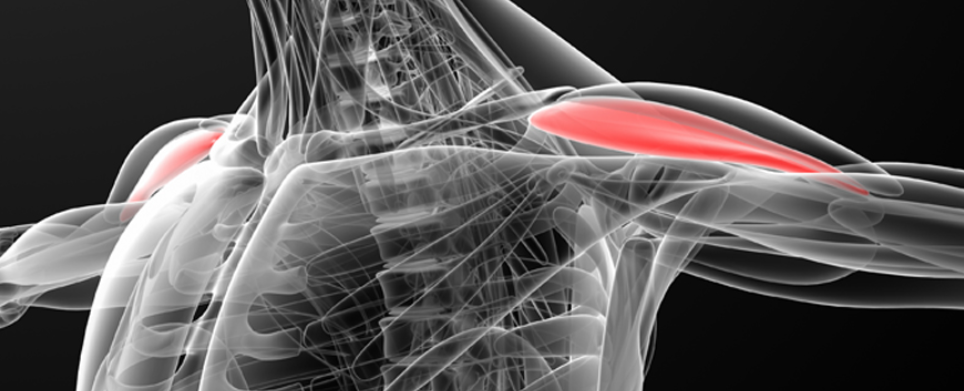 회전근개증후군이란