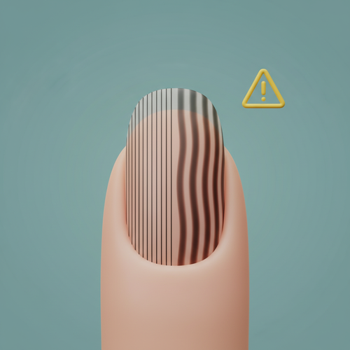 흑색종 의심해야 할 손톱 변화의 특징