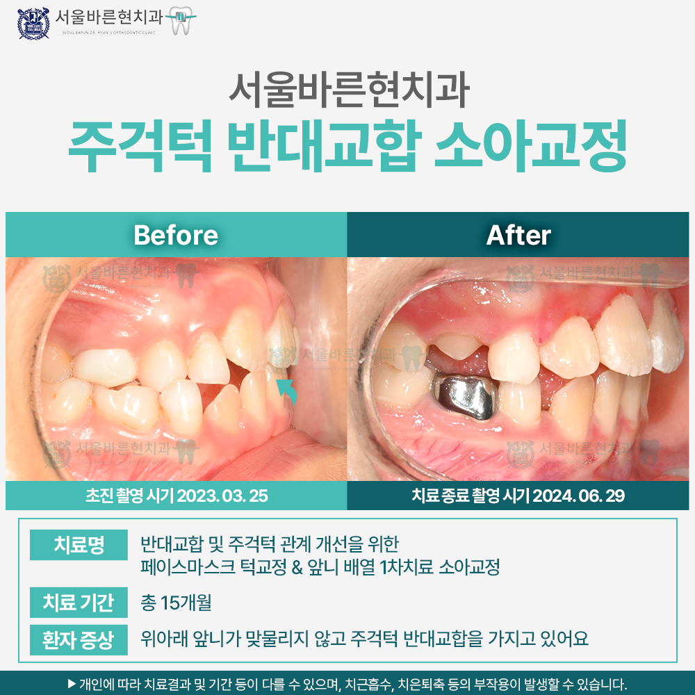부산소아교정