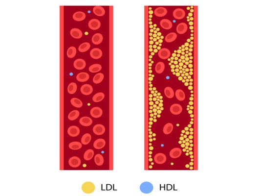 HDL(좋은 콜레스테롤)과 LDL(나쁜 콜레스테롤)