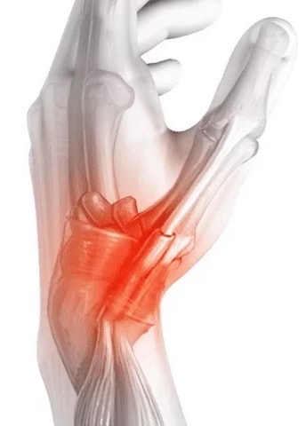 드퀘르뱅-디퀘르뱅-dequervain