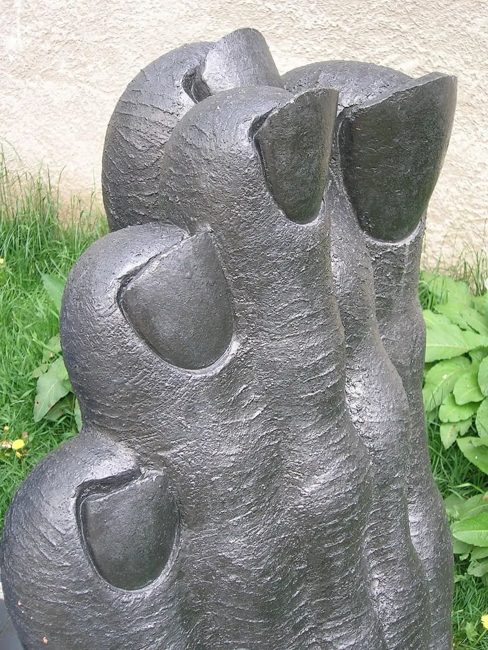 발톱흑색종 생존율과 치료법, 조기 발견이 답입니다