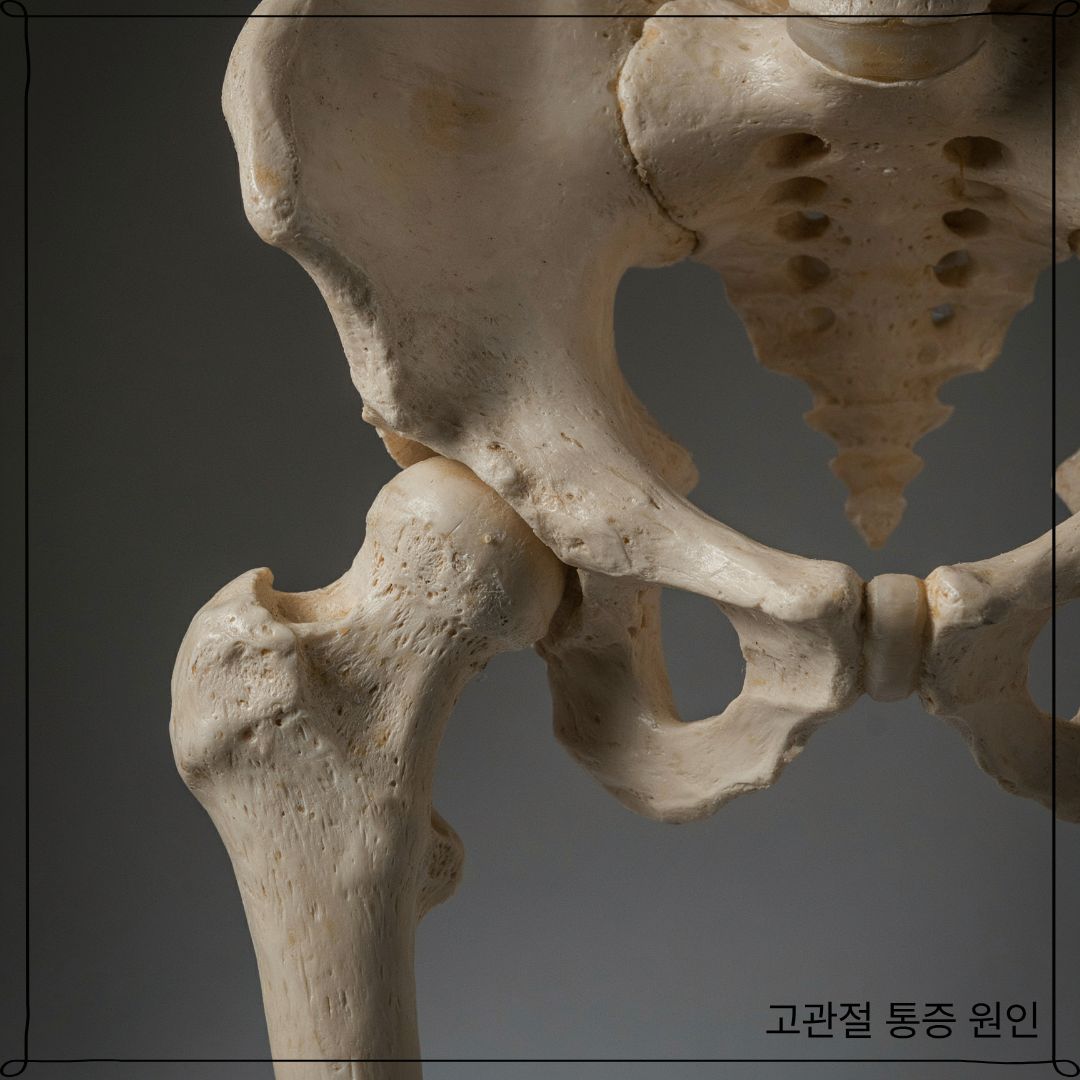 고관절 통증 원인