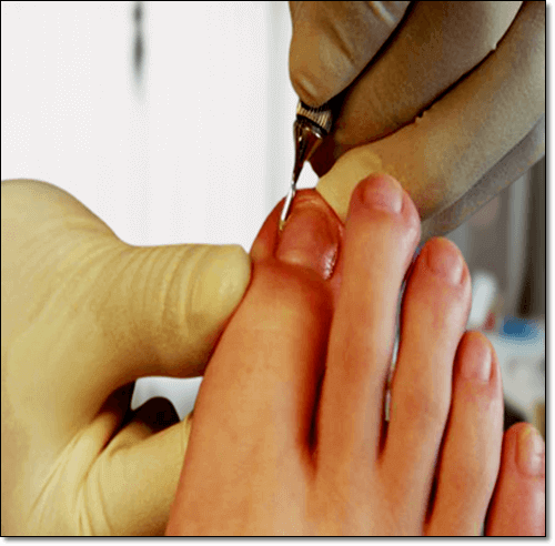 내성발톱 자가치료