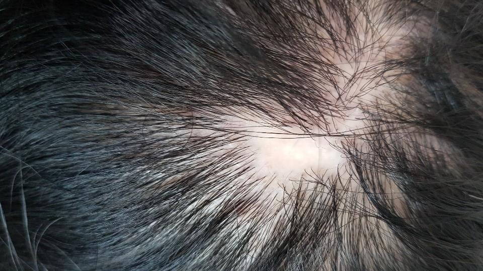 두피에 원형 반점의 탈모 사진