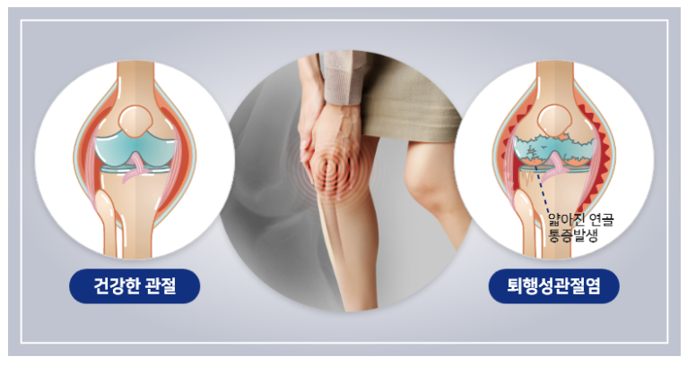 퇴행성 관절염
