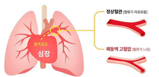 폐동맥고혈압 조기진단 생존율 폐동맥고혈압 폐고혈압증상 심장건강 호흡곤란 여성건강 난치병관리 심장내과 건강정보 심혈관질환