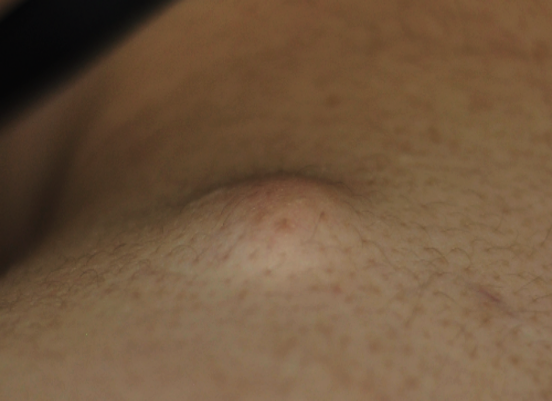 피지낭종 피부낭종 사진