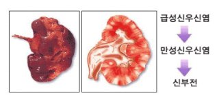 신우신염의 원인과 증상
