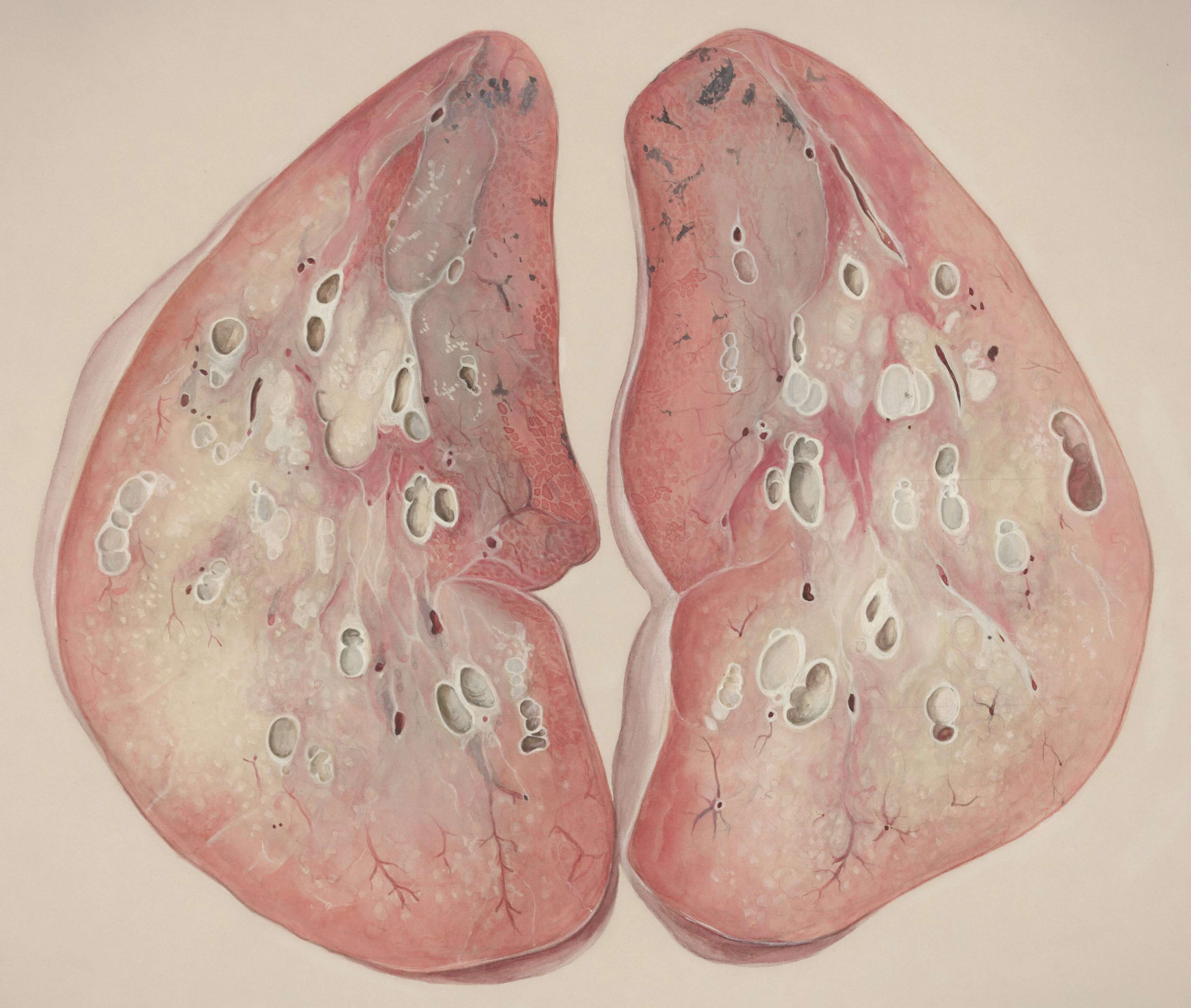 폐암 초기증상 10가지 확인법