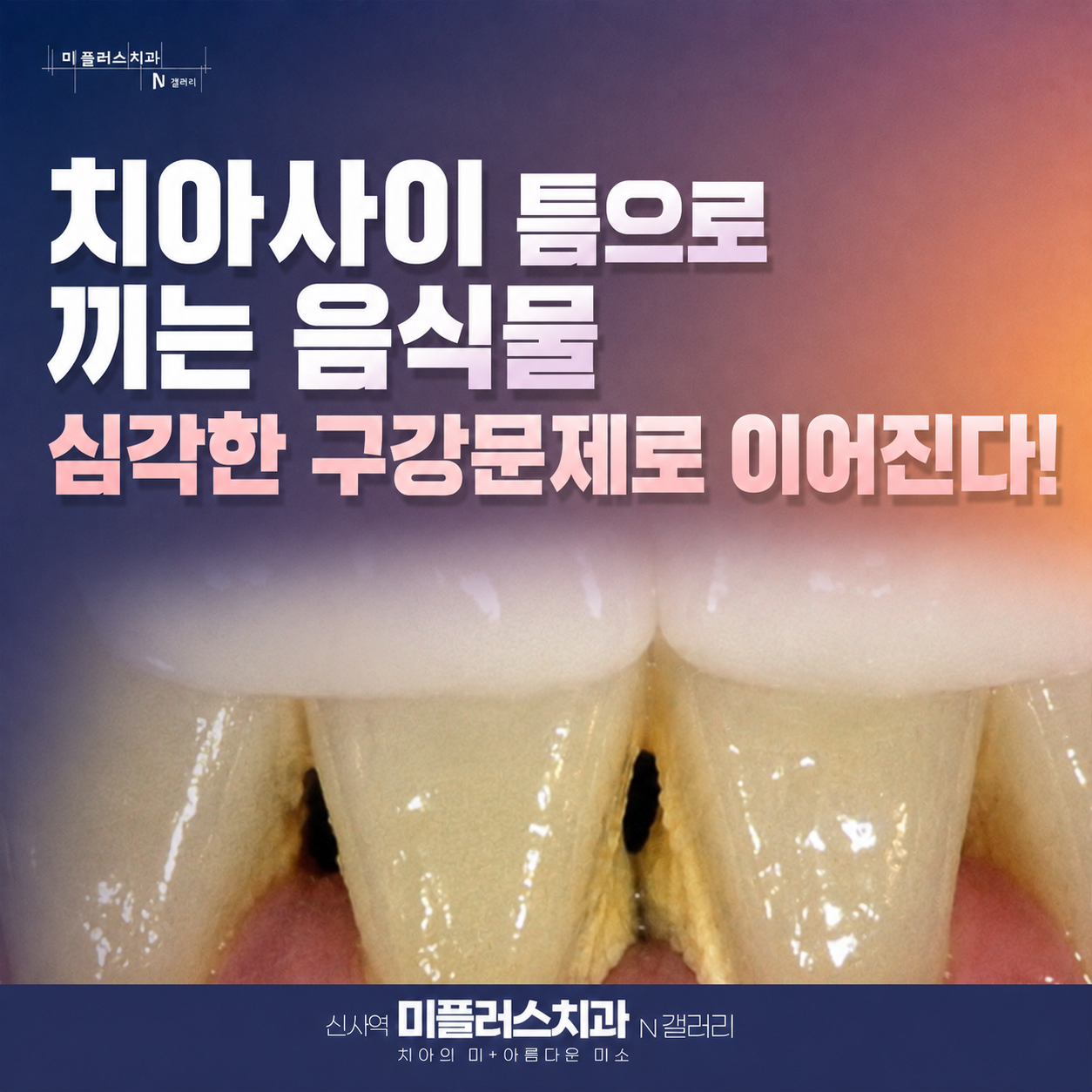 블랙트라이앵글로 치아 사이에 음식물이 끼고 잇몸 건강에 영향을 주는 모습