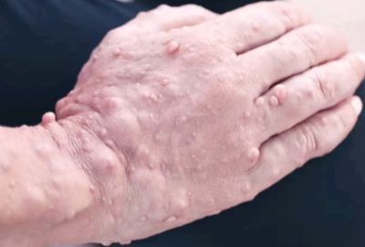 신경섬유종 증상