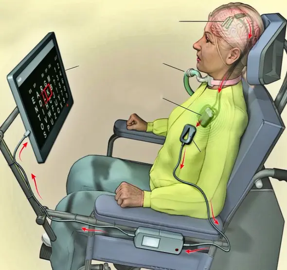 뇌임플란트-NEJM 제공