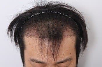 모발이식 후기