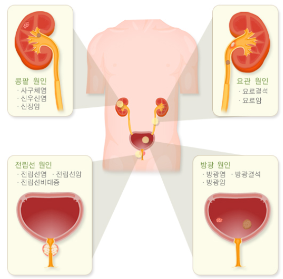 혈뇨가 나오는 이유 3