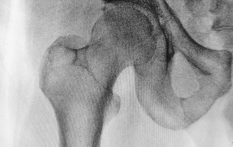 엑스레이-뼈사진