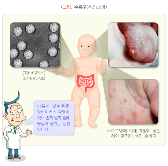 수족구병 증상 및 예방법