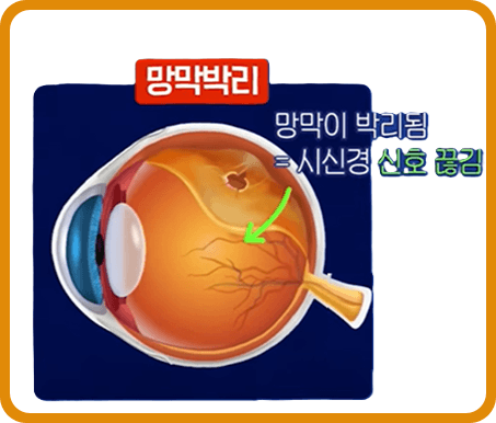 눈 검은것이떠다니는것