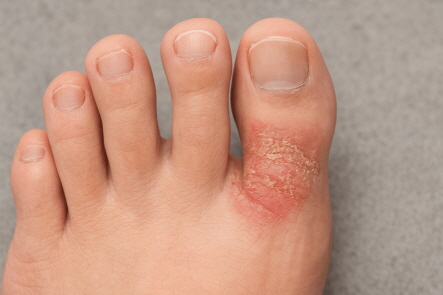 무좀이 생긴 발가락 사진