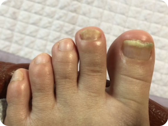 발톱 무좀 22주차