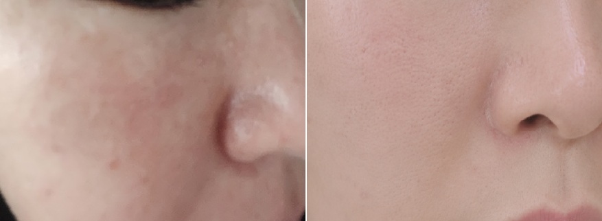 주사피부염과 안면홍조 관리 전후 피부 상태 비교 사진으로 붉은기와 피부결 변화가 보이는 모습
