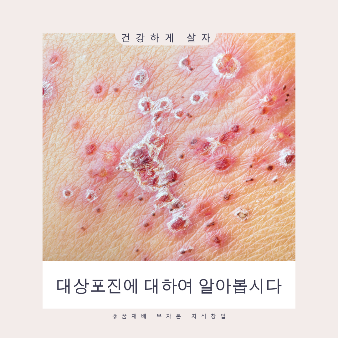 대상포진
