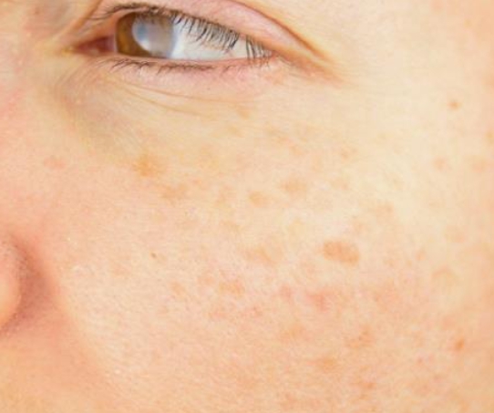 멜라토닝크림 효과