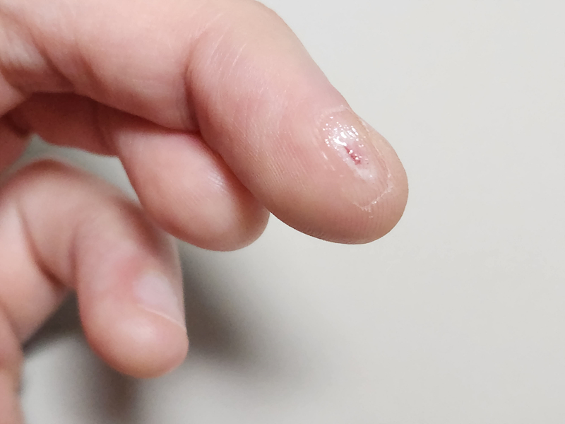 상처부위-보호-소독효과-프리덤폼