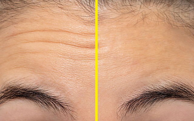 이마 주름 없애는법, 이마주름 없애는 마사지,뷰티 팁줌